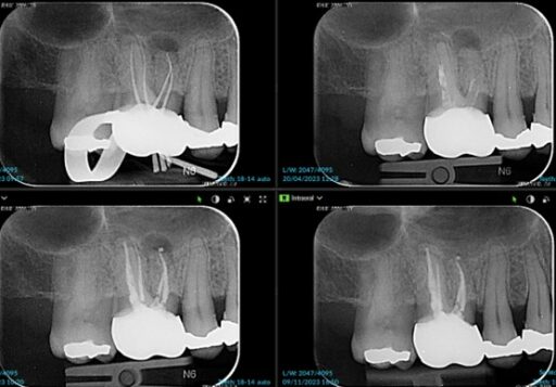 6 months healed apical lucnecy UR6 after re-RCT